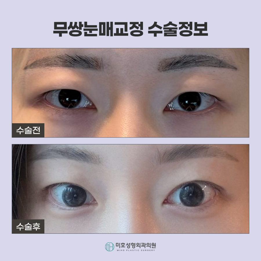 무쌍눈매교정 자연스러운 눈매 완성 관련 이미지 7