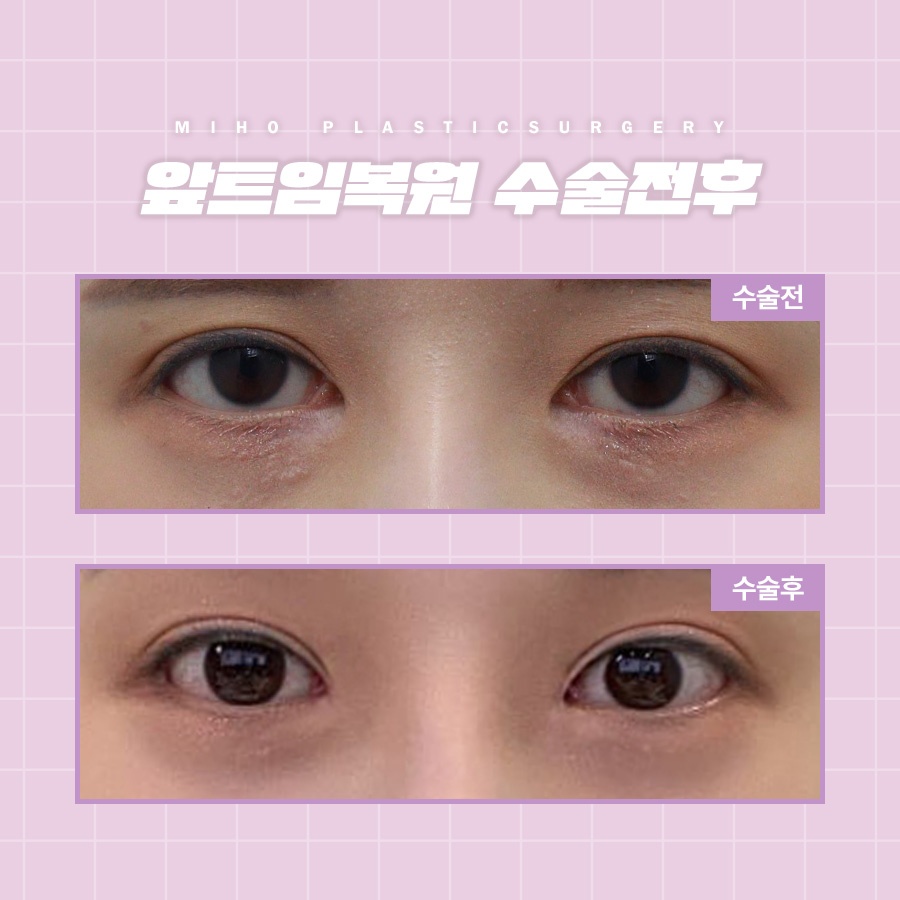 앞트임복원 새롭게 자리 잡도록 관련 이미지 7