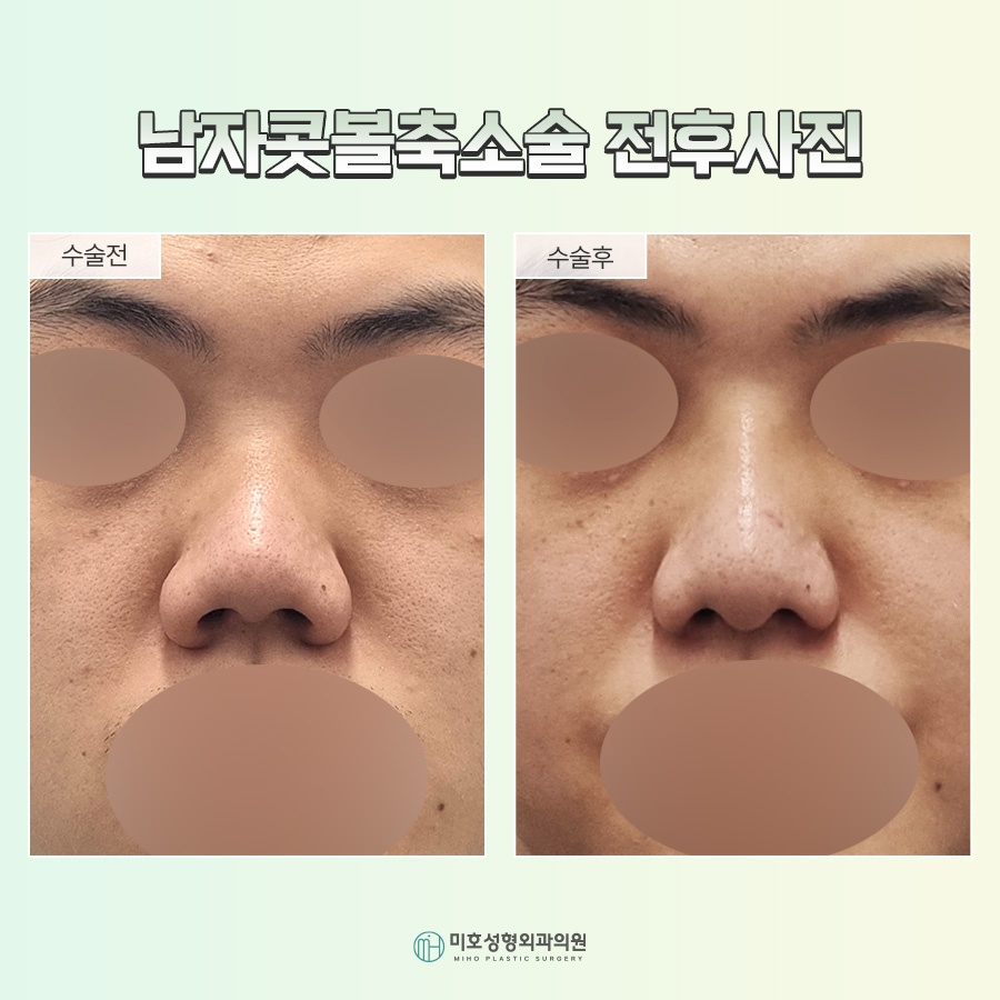 A Successful Guide to Male Alar Reduction for a Refined Appearance image 8