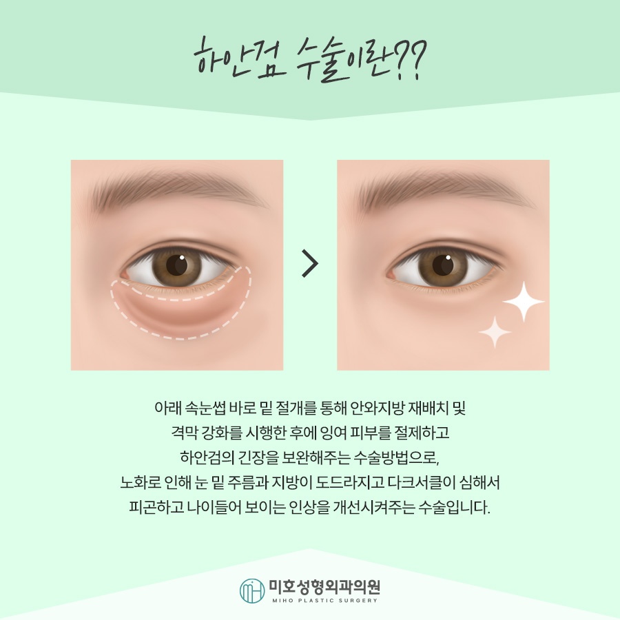 If Lower Blepharoplasty Is Needed for Drooping Eyes image 2