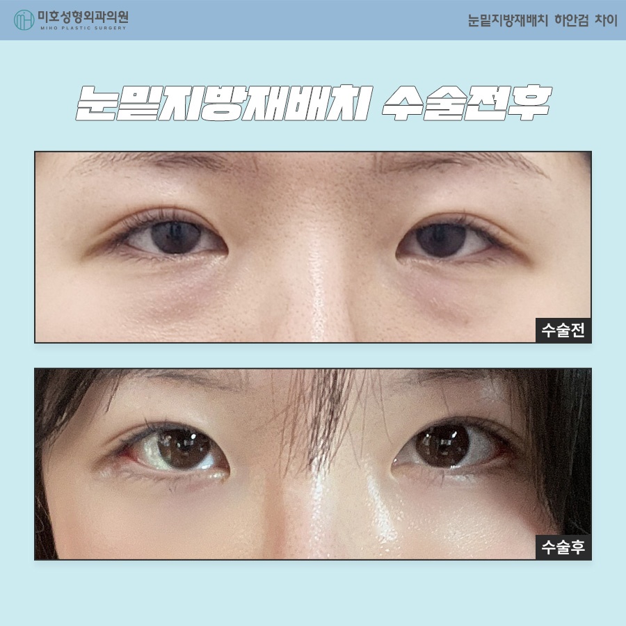 How to Choose Between Under-Eye Fat Repositioning and Lower Blepharoplasty image 7