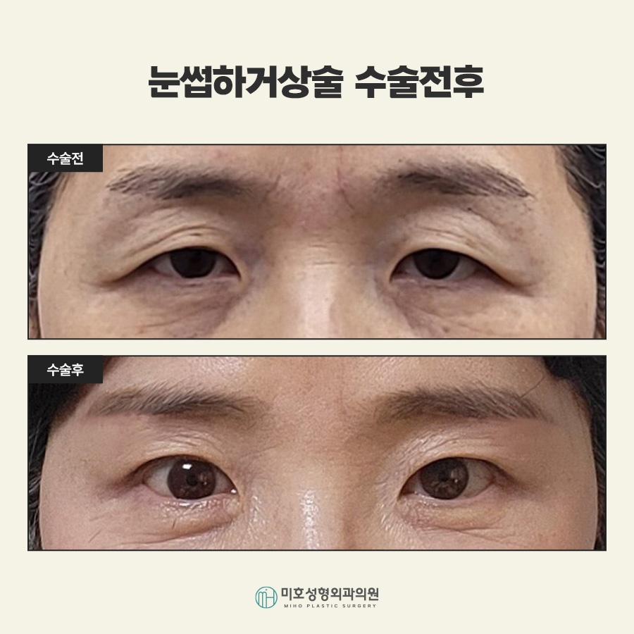Sub-Brow Lift for Softening a Heavy Appearance image 7