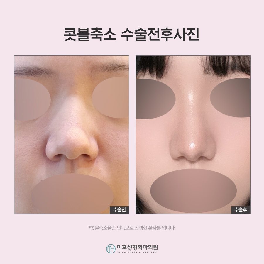 콧볼축소 자연스러운 코라인을 위한 체크포인트 관련 이미지 7