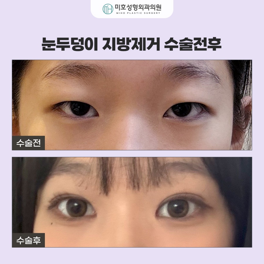 눈두덩이지방제거 눈매 개선 가이드 관련 이미지 9