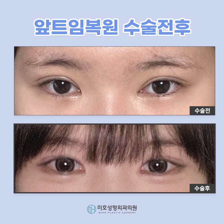 앞트임복원 및 라인 변화를 원한다면 관련 이미지 7