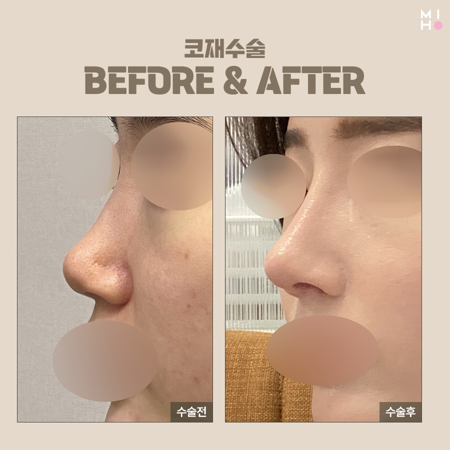 Revision Rhinoplasty Cost: Proceed Carefully, Since This Is a Second Attempt image 8