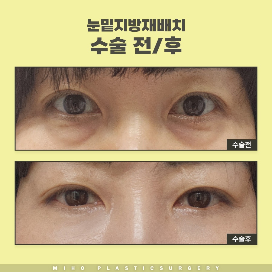 눈밑지방재배치수술비용 내게 맞는 수준은 관련 이미지 8