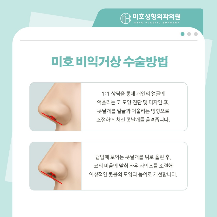 미호 비익거상 자연스러운 콧날개올리기 비율교정! 관련 이미지 5