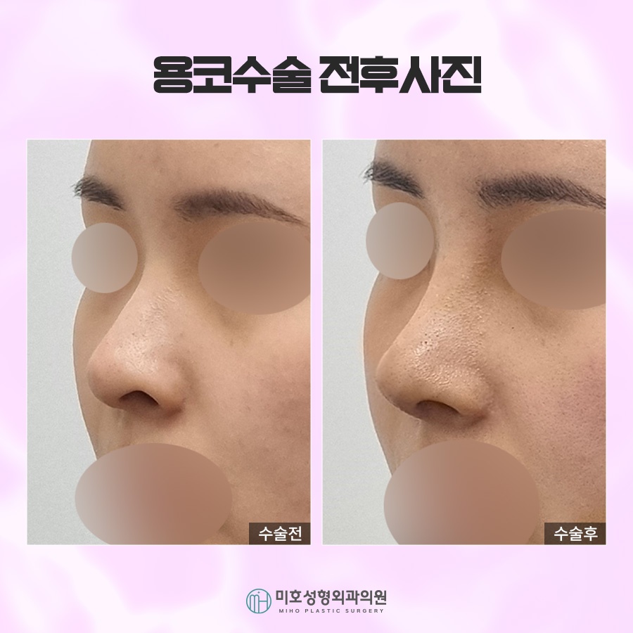 Through Drooping Nostril Correction in Bulbous Nose Surgery image 7