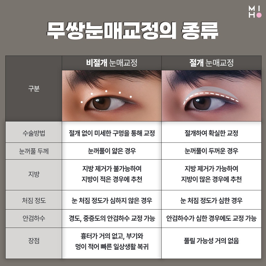 무쌍눈매교정 상황에 따른 개선법 관련 이미지 5