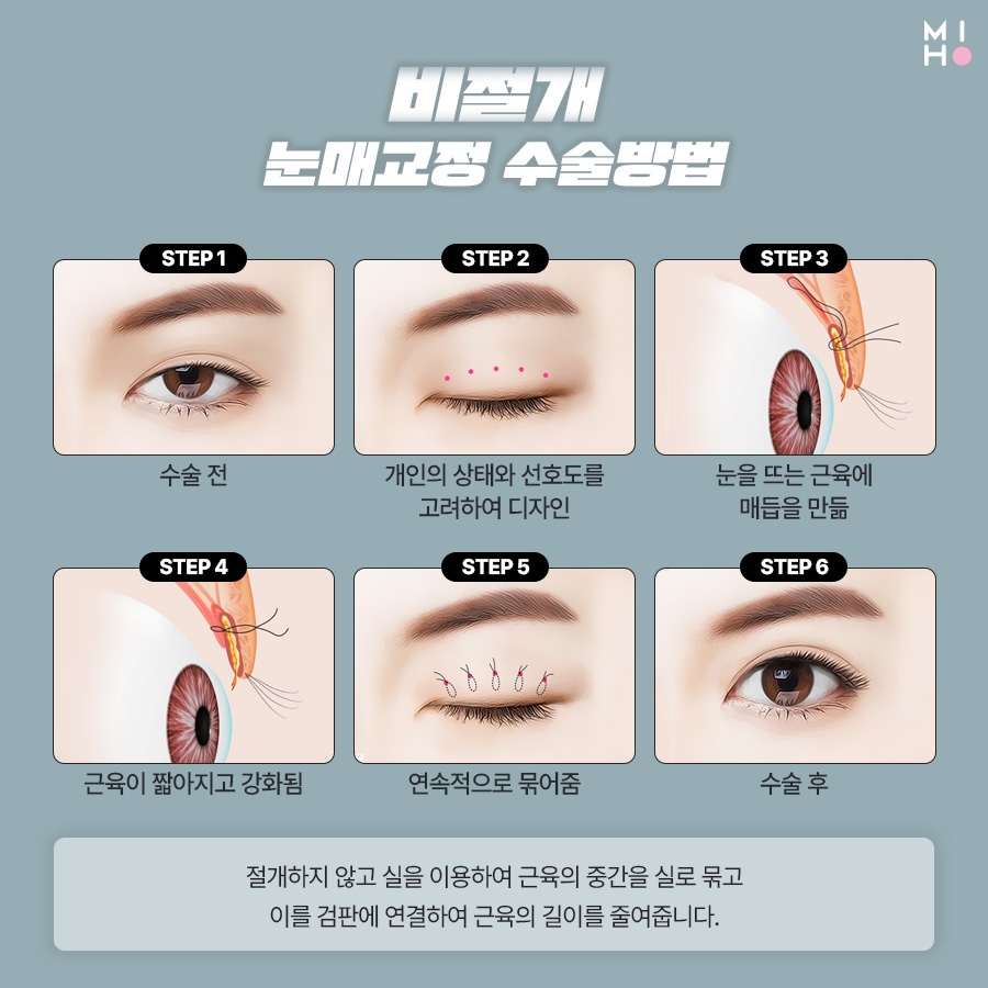 남자눈매교정 무쌍부터 유쌍까지 시원하게 관련 이미지 4