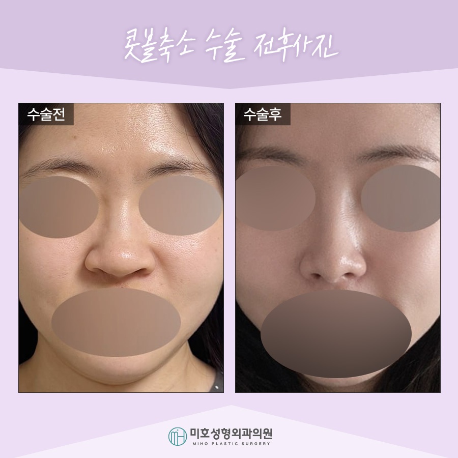 Nasal Alar Reduction in a Natural Direction image 8