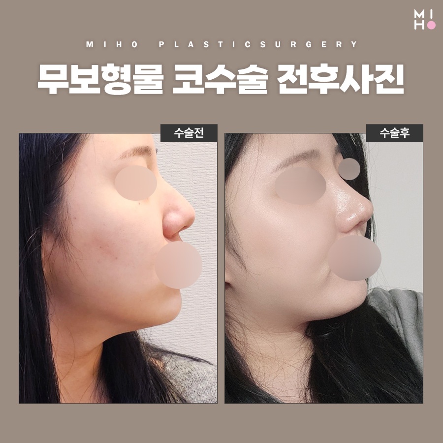 무보형물코수술 부담 없는 모양 개선 관련 이미지 8