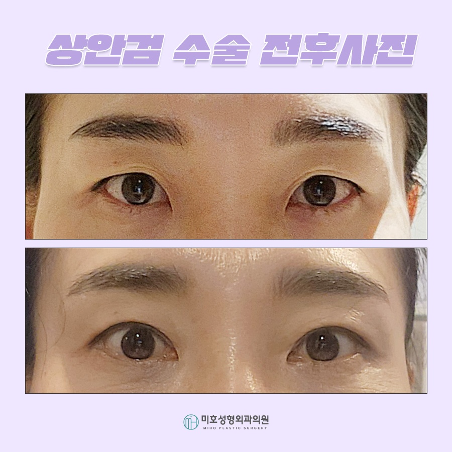 상안검수술 해당하는 유형은 관련 이미지 9