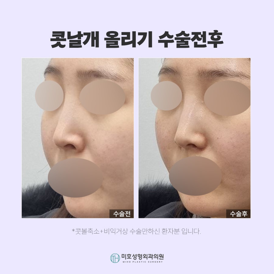 콧날개올리기 비익거상 기준 살펴보고 관련 이미지 7