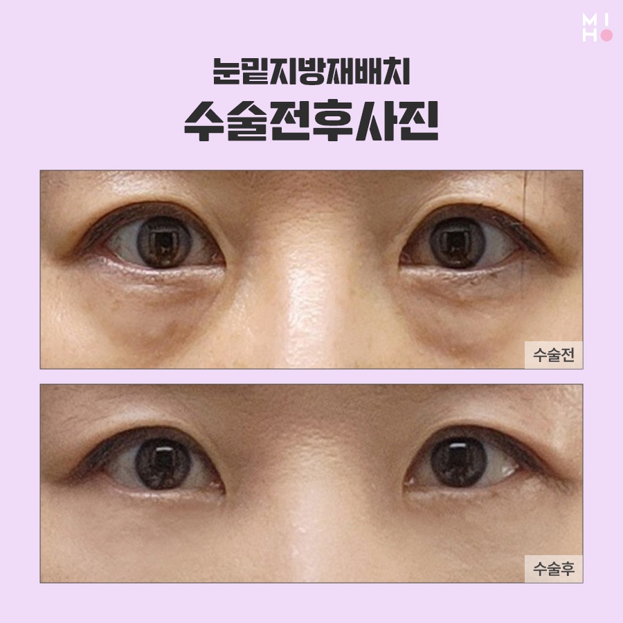 눈밑지방재배치 보완할 곳을 파악하여 관련 이미지 9