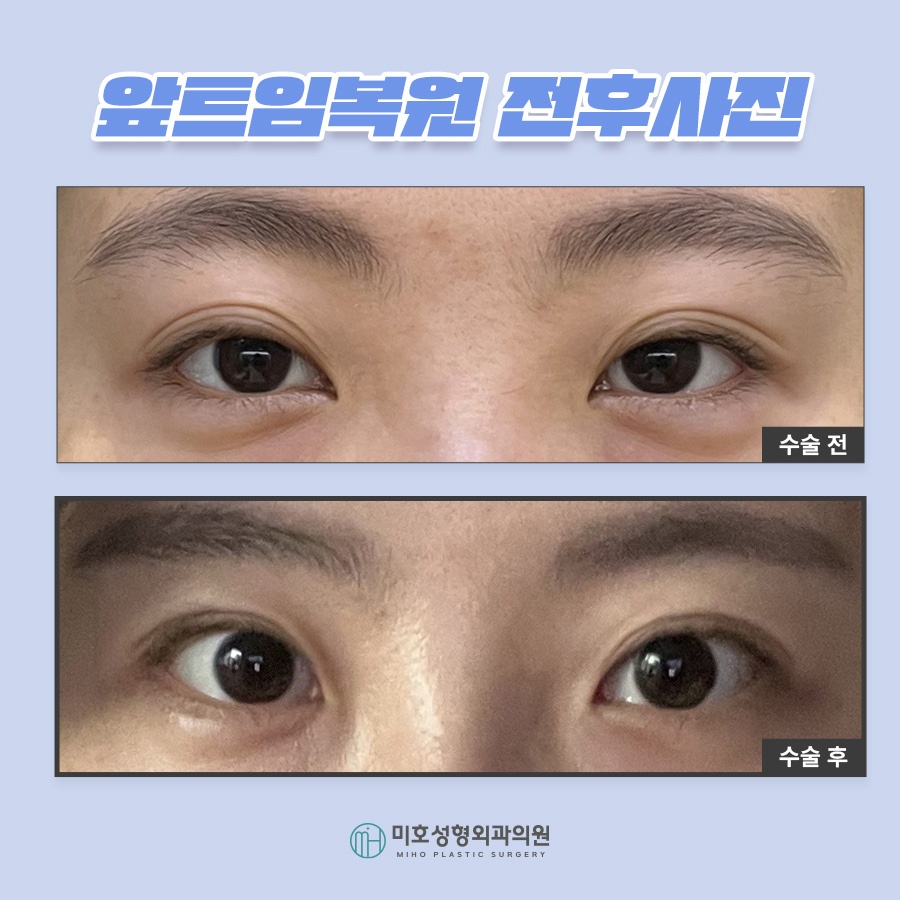 앞트임복원 제대로 알기 관련 이미지 9