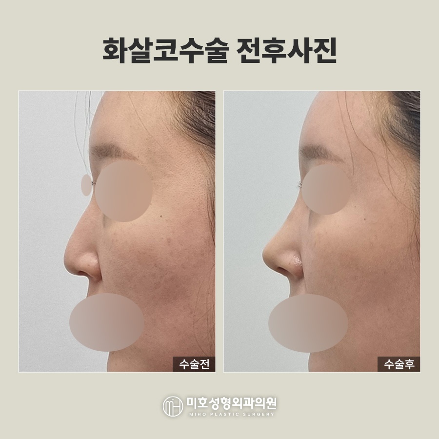 화살코 처진 코끝 교정으로 세련된 인상 만들기 관련 이미지 6