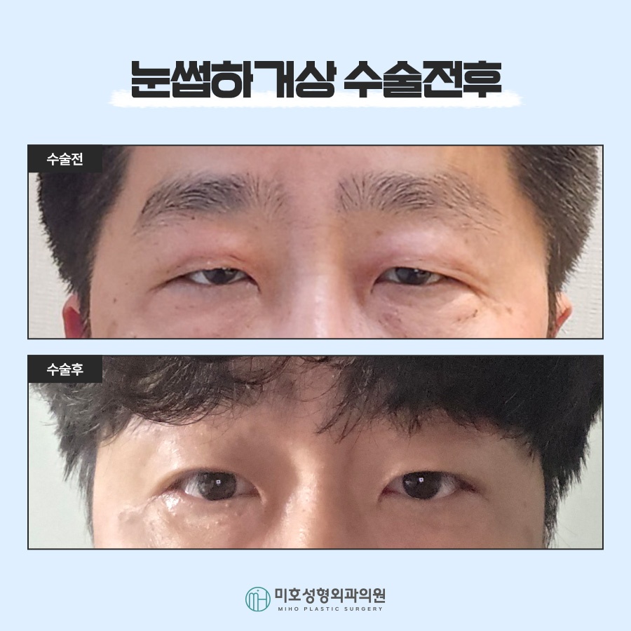 눈썹하거상 노안형 얼굴에 변화를 주려면 관련 이미지 9