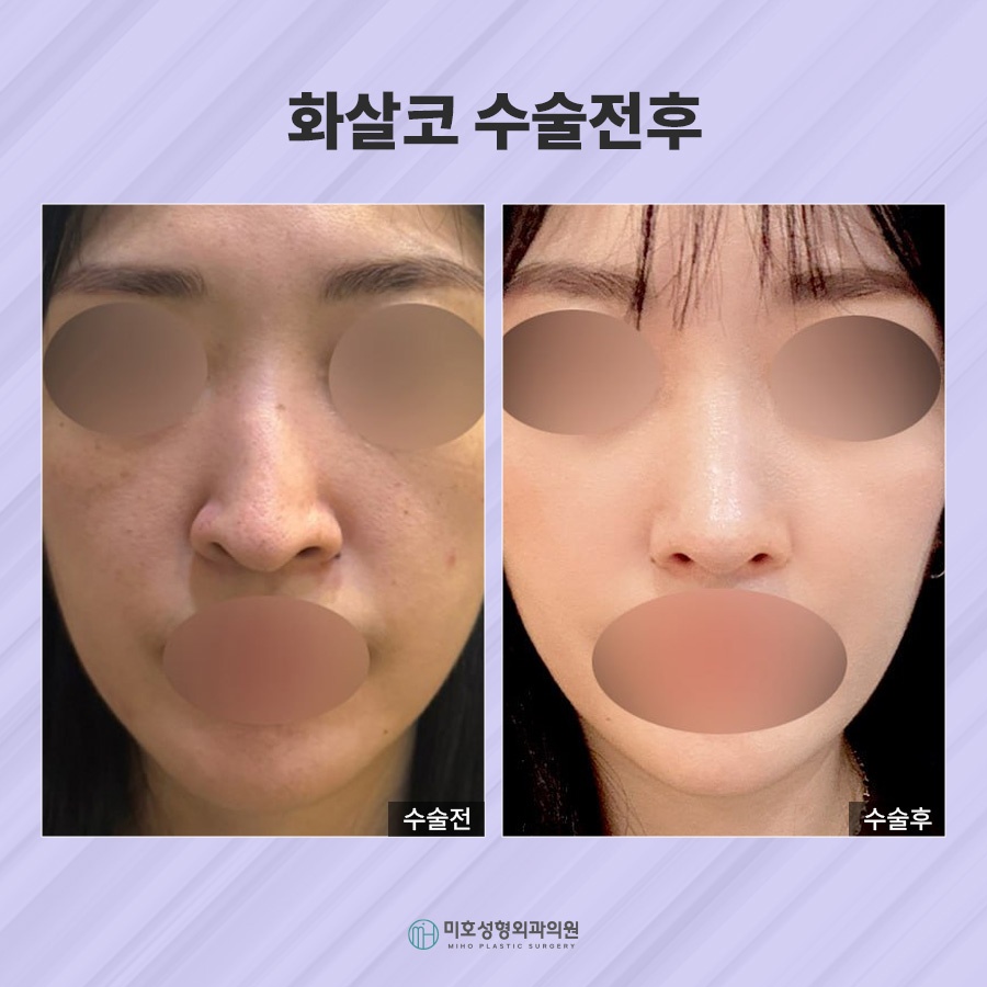 화살코 교정 방법 및 관리수칙 관련 이미지 7
