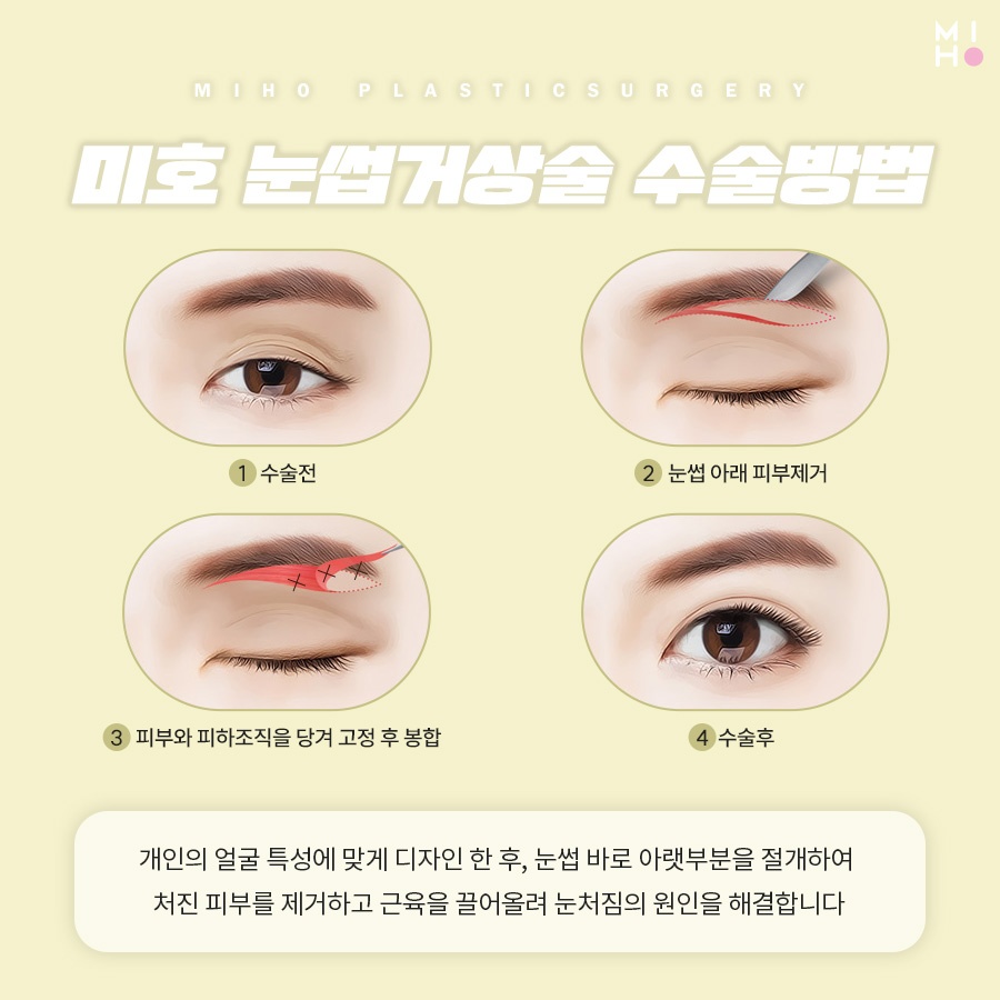 Brow Lift Review: You Could Be the Next Success Story image 3