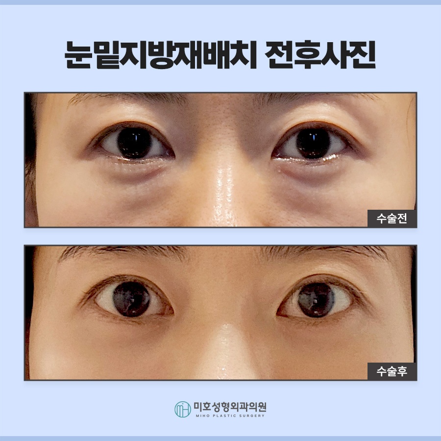 눈밑지 다크서클 처짐 고민된다면 관련 이미지 10
