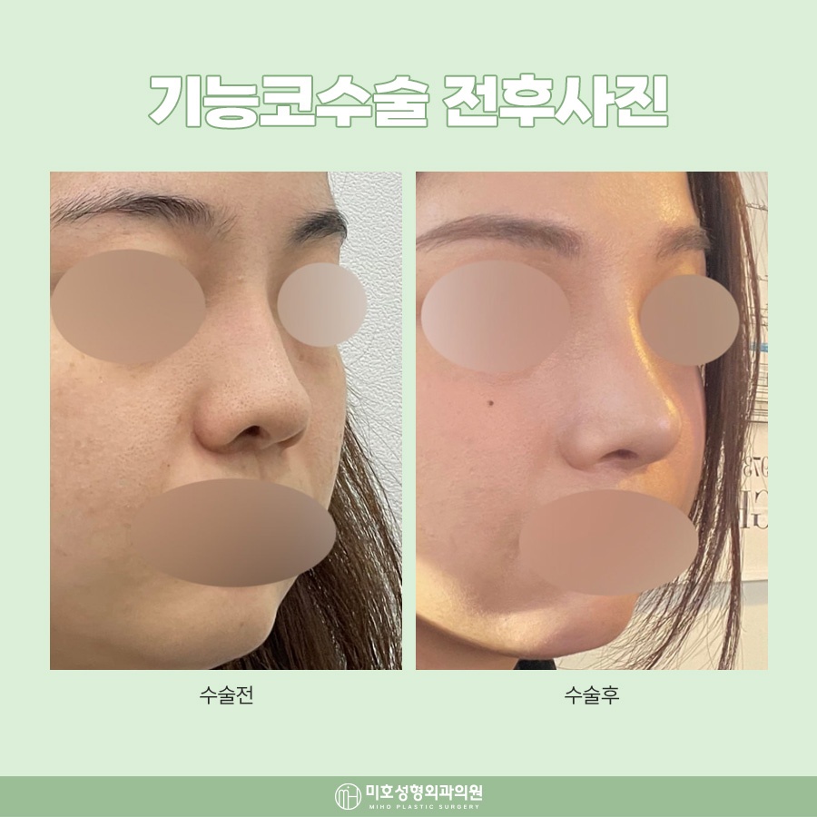 하비갑개절제술 코막힘 개선 방법 관련 이미지 8