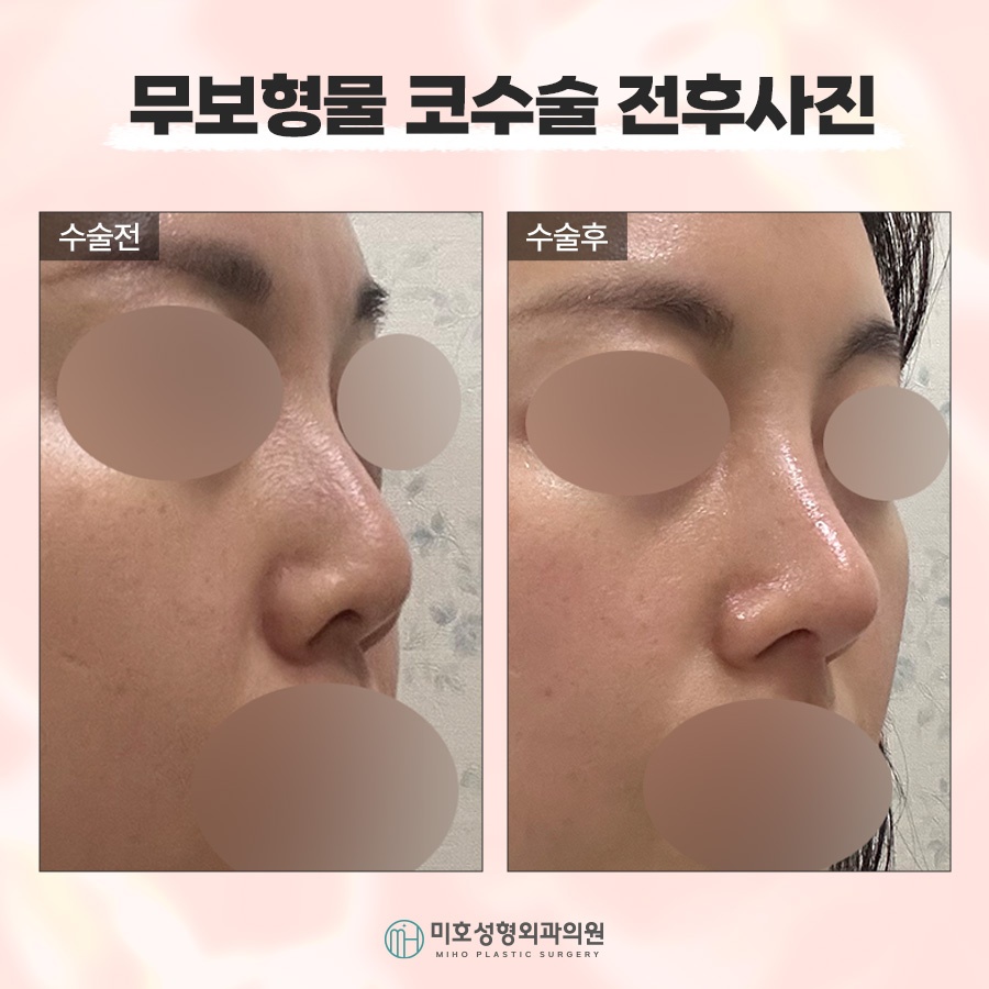If You Want Harmonious Lines with Nose Surgery Without Implants image 10