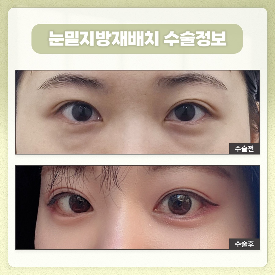 눈밑지방재배치 피로한 인상을 관련 이미지 8