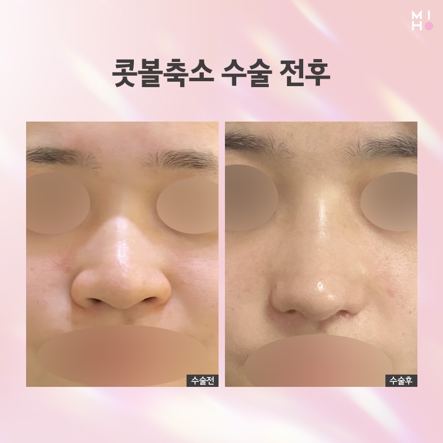 How Alar Reduction Surgery Is Performed and What to Expect in the Future image 8