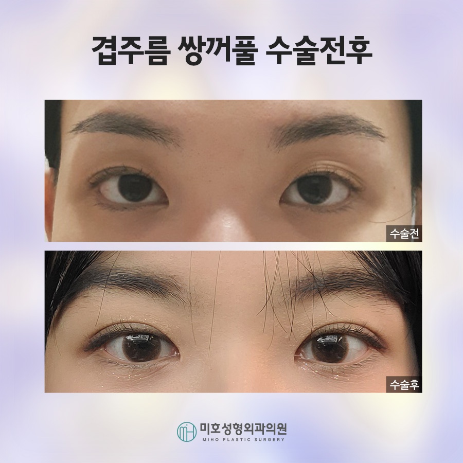 겹쌍꺼풀 깔끔하게 정돈하려면 관련 이미지 8