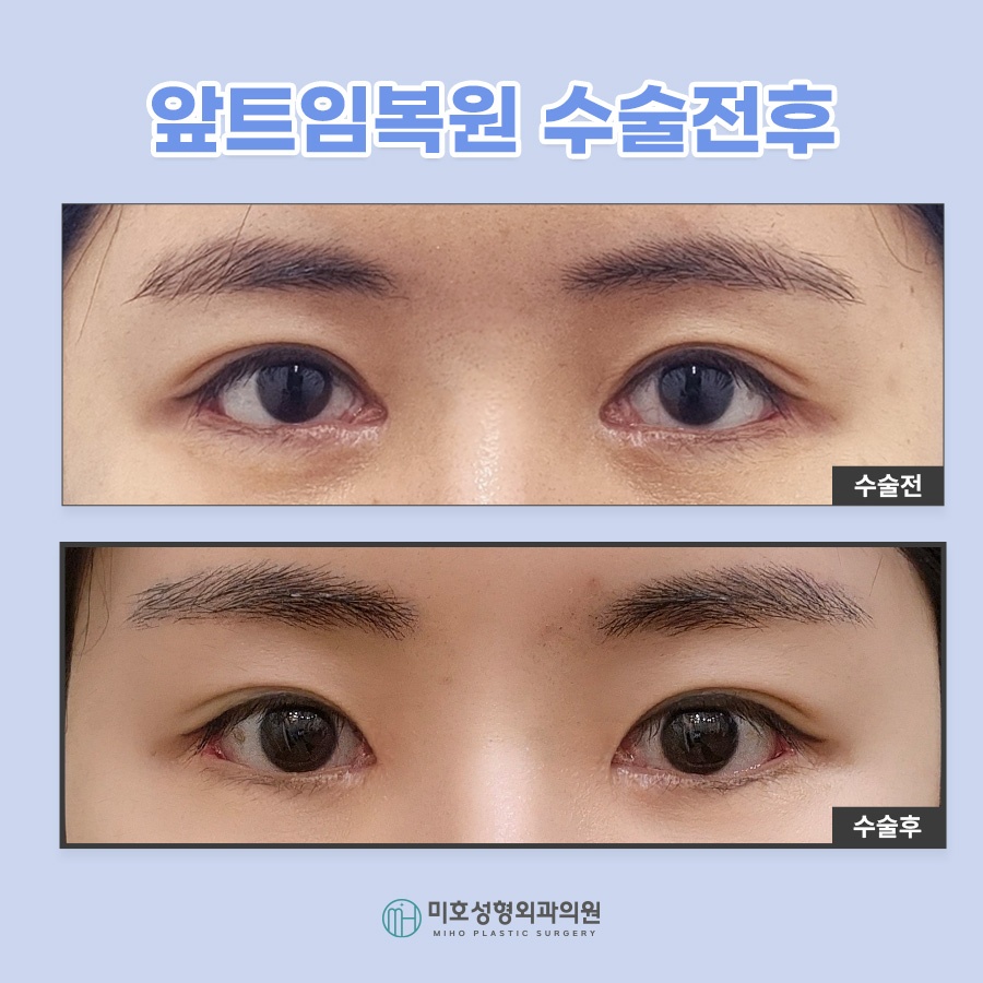 앞트임복원 및 라인 변화를 원한다면 관련 이미지 8