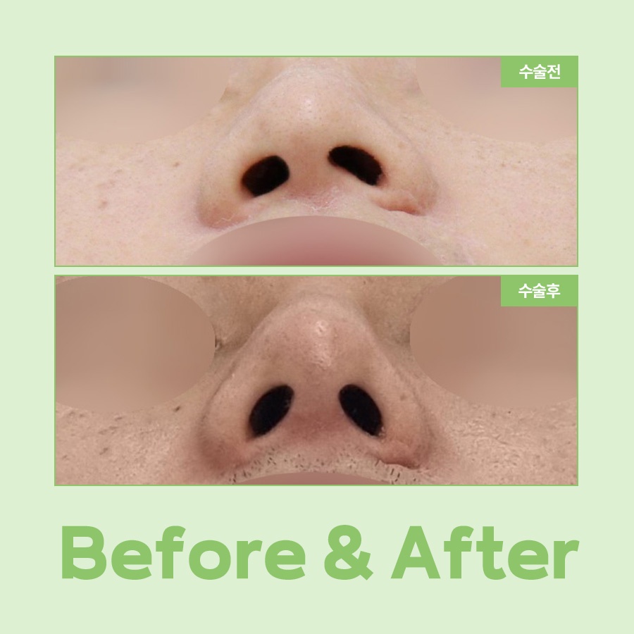 A Complete Guide to the Causes of Uneven Nostrils and the Timing of Revision Rhinoplasty image 8