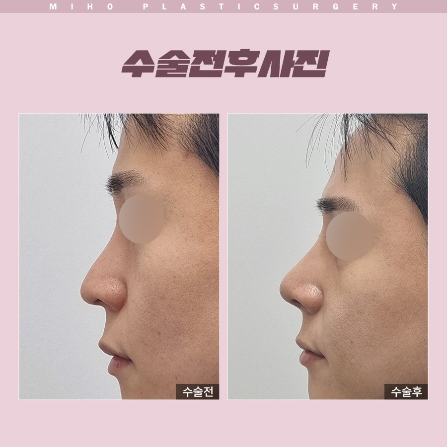 화살코 개선 전 체크리스트 6가지 관련 이미지 7