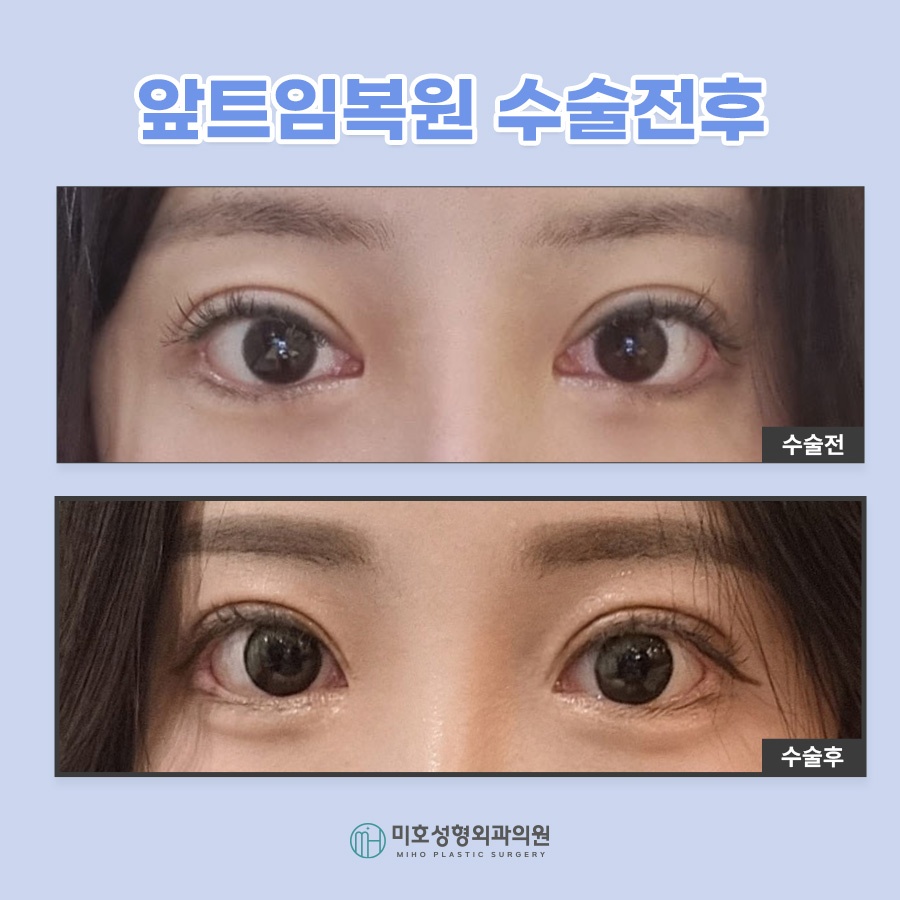 앞트임복원 및 라인 변화를 원한다면 관련 이미지 9
