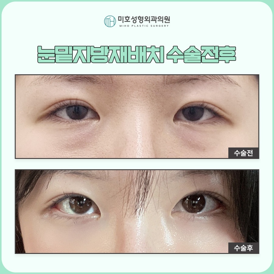 눈밑지 후기보다 의료진 실력이 중요 관련 이미지 7