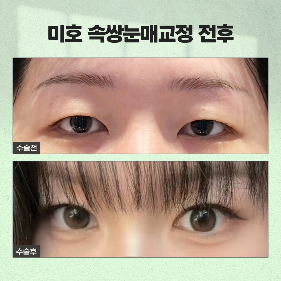 속쌍눈매교정 또렷한 눈매를 원할때 관련 이미지 7