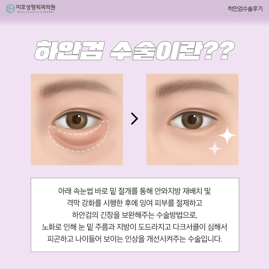 하안검수술후기 주인공이 되는 법 관련 이미지 2