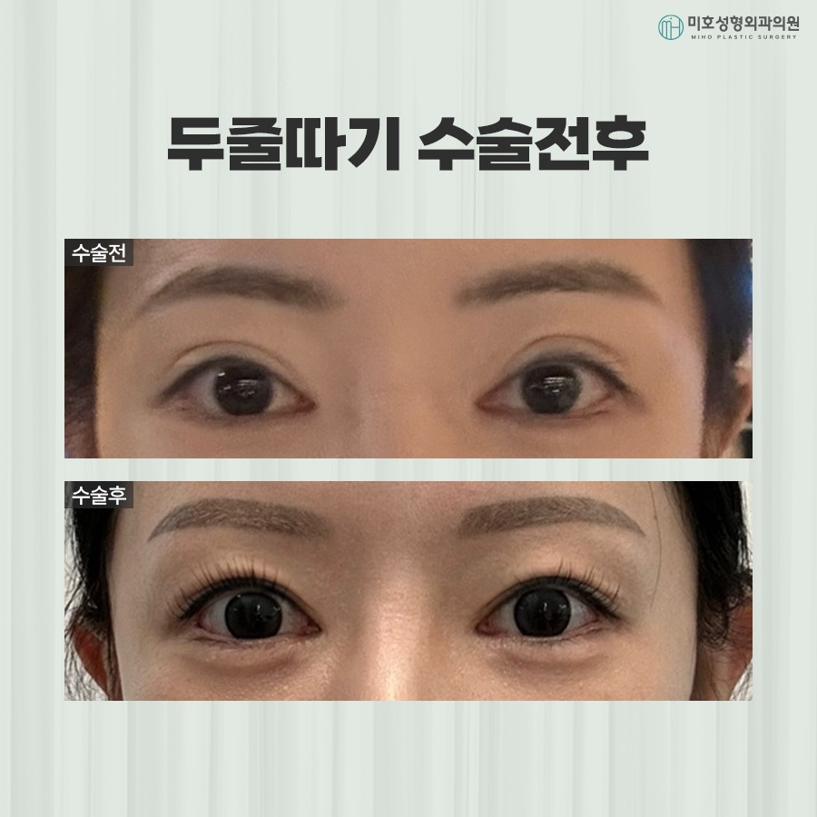 Differences Between One-Line and Two-Line Correction and Causes of Sausage Eyes image 6