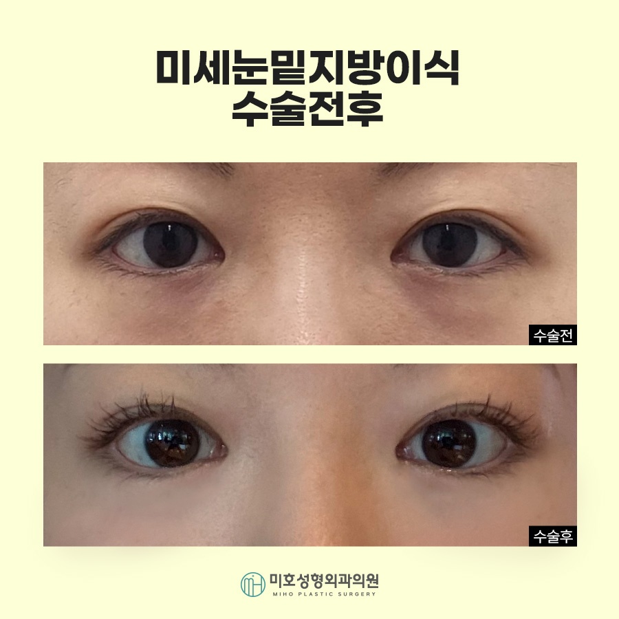 눈밑지방이식 자연스러운 입체감 완성 관련 이미지 7