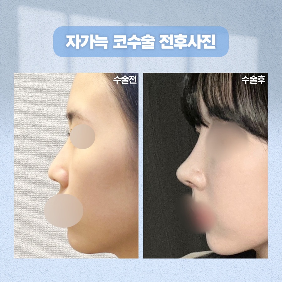 자가늑코수술 재료 특성과 회복 과정 관련 이미지 9