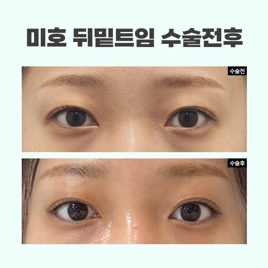 뒷트임밑트임후기 주의할 점 관련 이미지 10