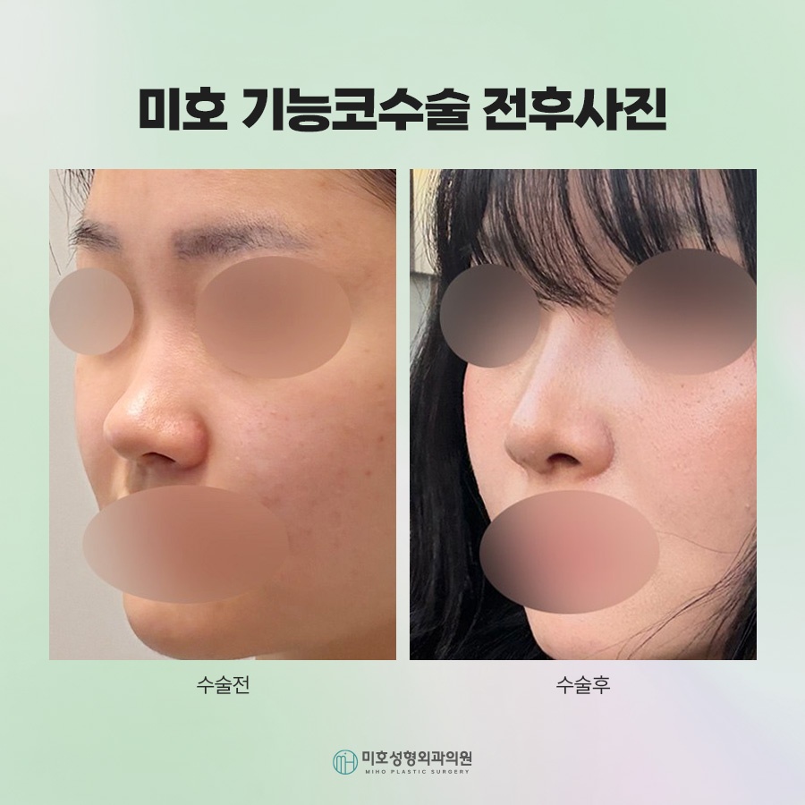 Who May Need Inferior Turbinate Reduction and How to Choose the Appropriate Method image 10