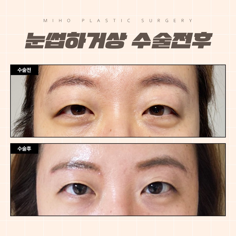 눈썹하거상 처진 눈꺼풀 또렷하게 관련 이미지 8