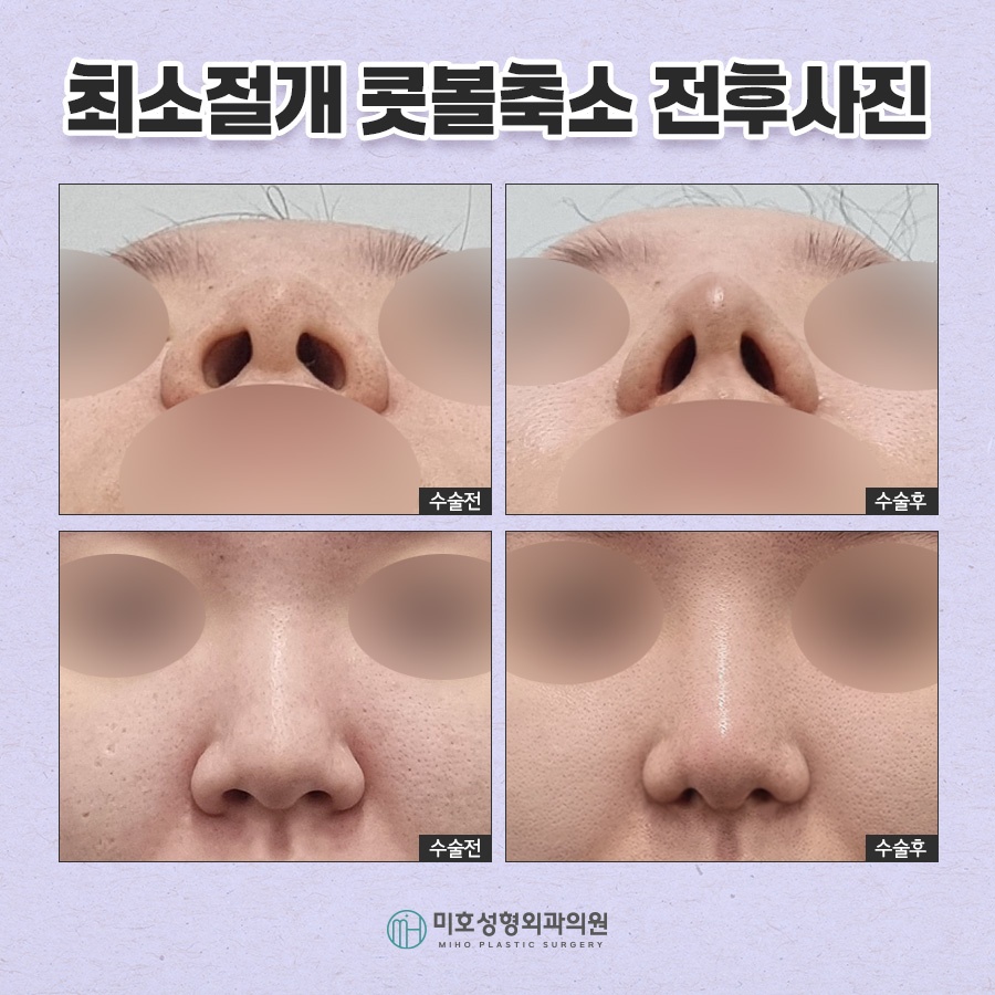 Refining Nostril Reduction in a Sophisticated Way image 7
