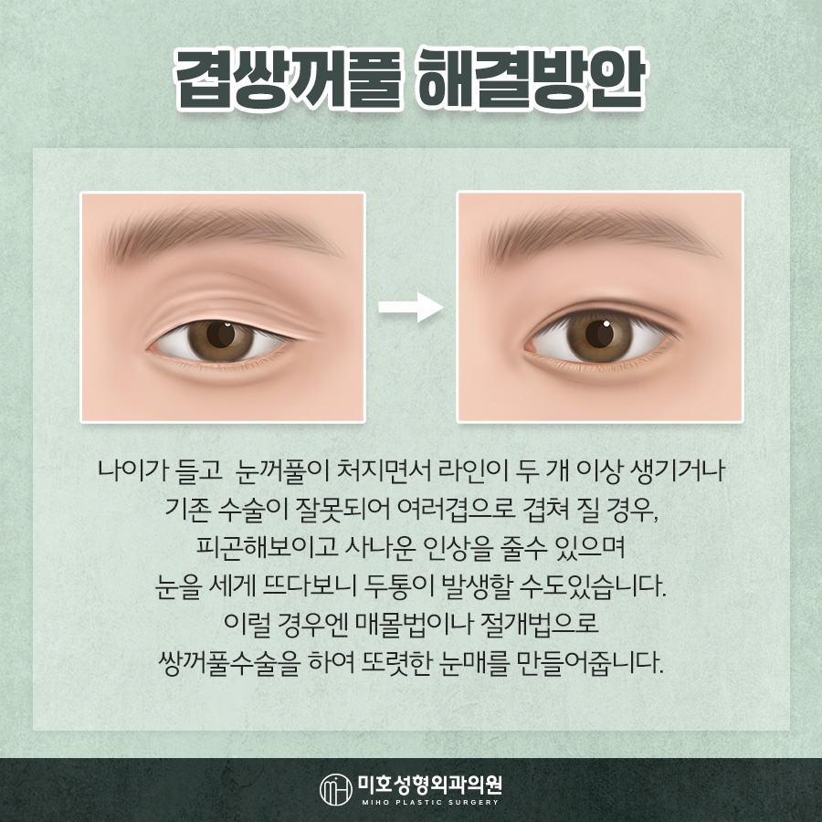 겹주름교정 자연스럽게 완성하려면 관련 이미지 5