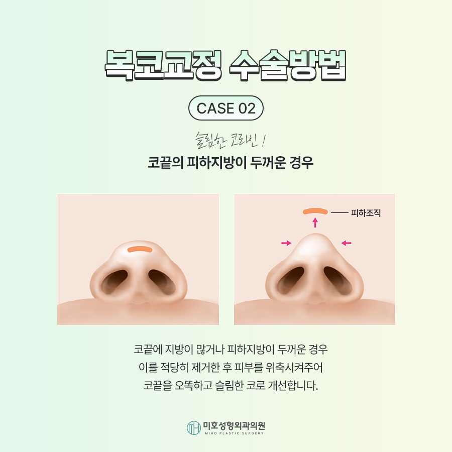 Nose Tip Refinement for a More Defined Impression image 5
