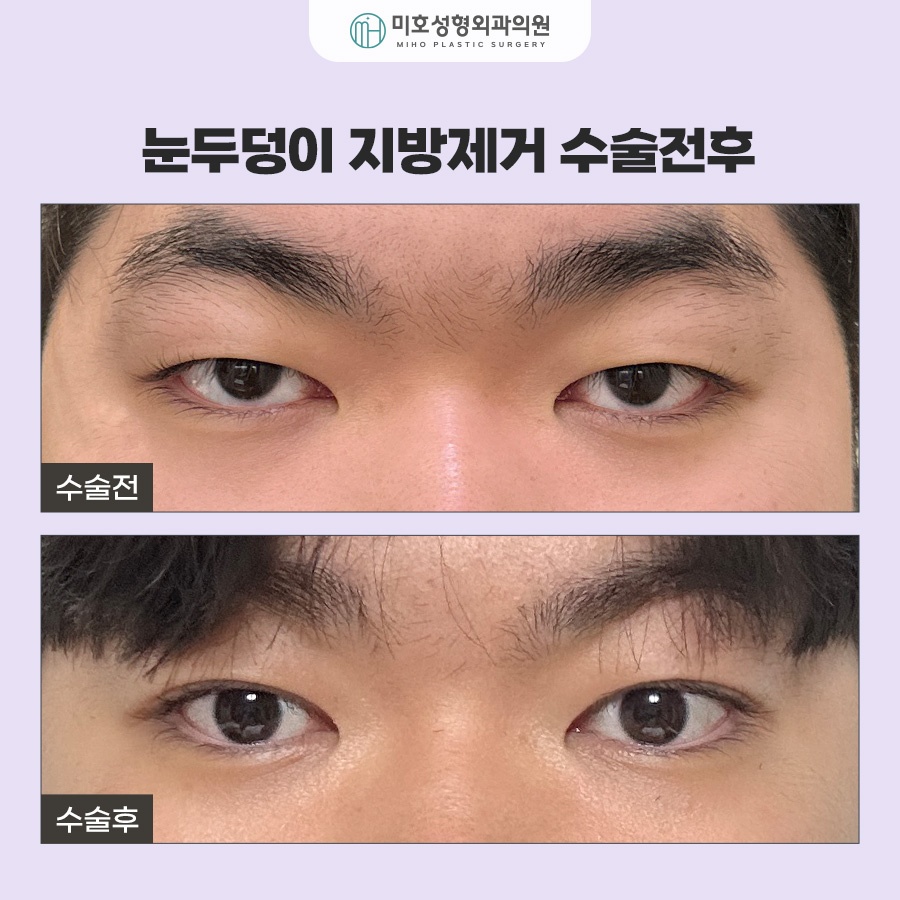 눈두덩이지방제거 눈매 개선 가이드 관련 이미지 8