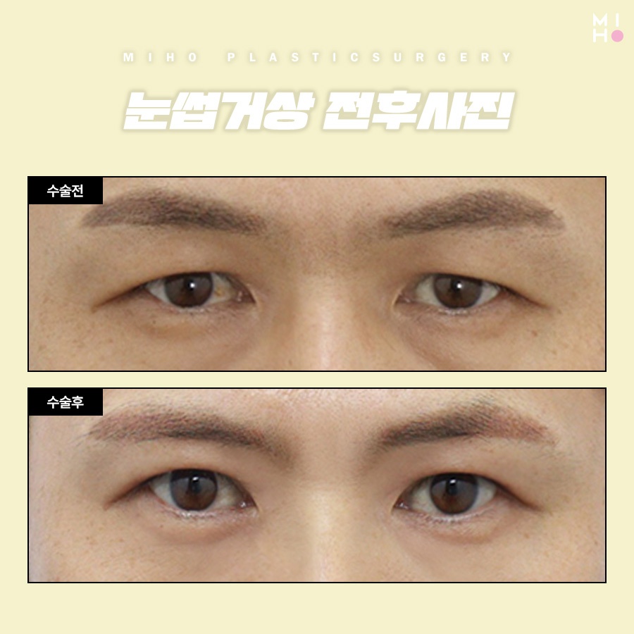 Brow Lift Review: You Could Be the Next Success Story image 6