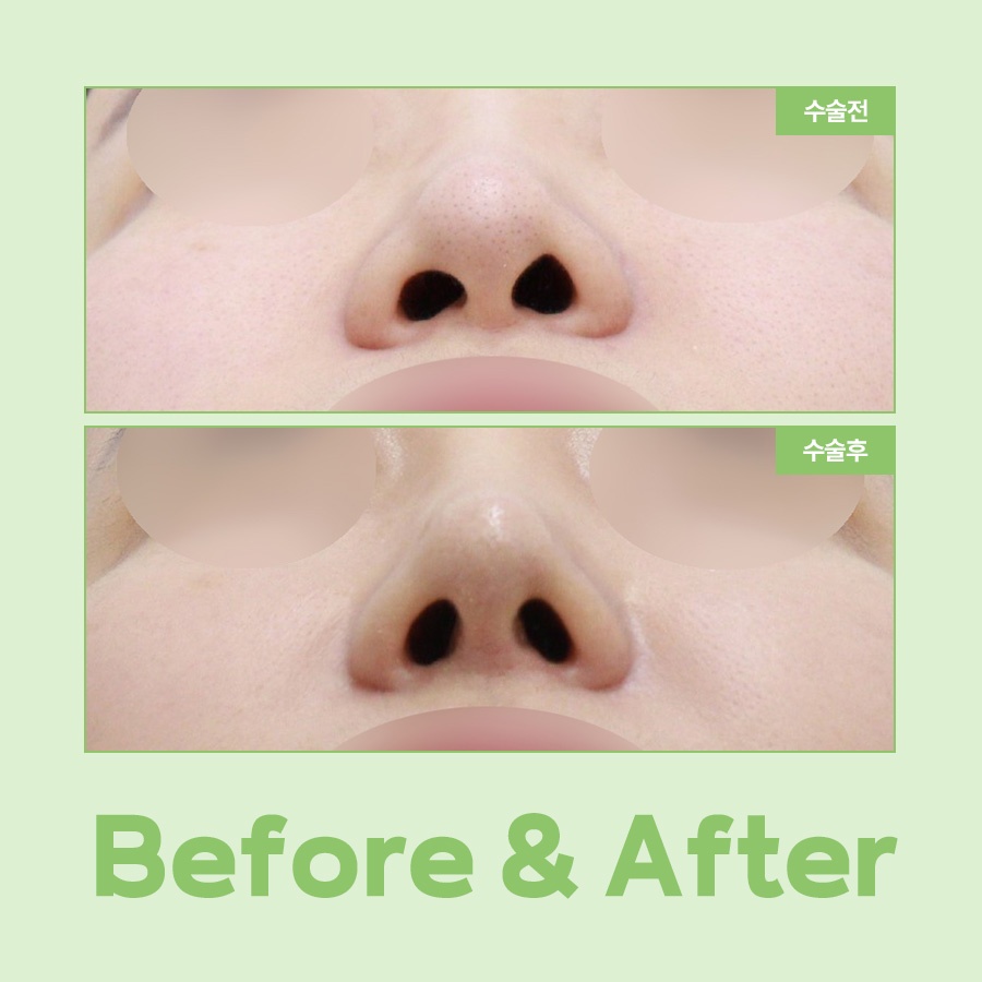 A Complete Guide to the Causes of Uneven Nostrils and the Timing of Revision Rhinoplasty image 7